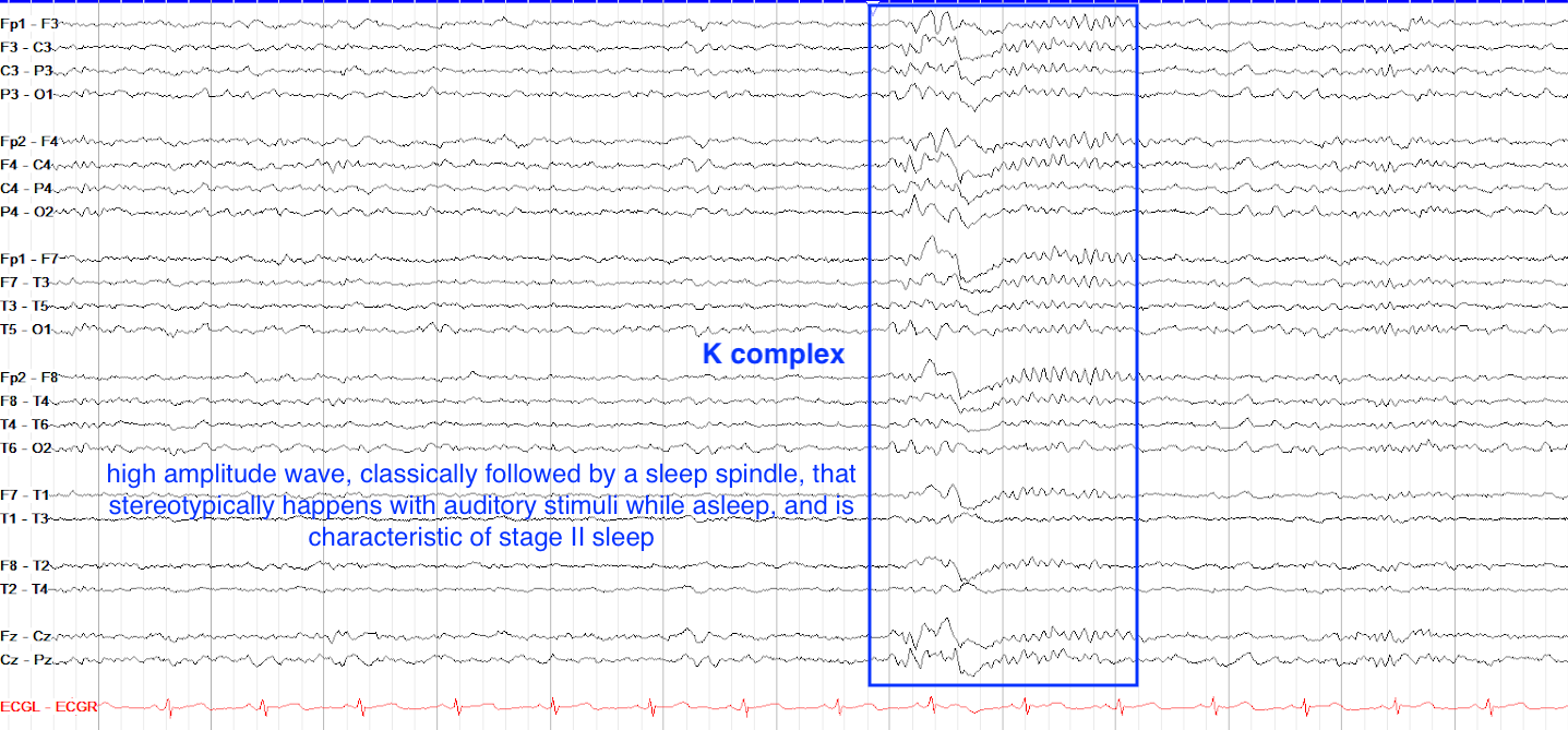 K Complex, Spindles, POSTs